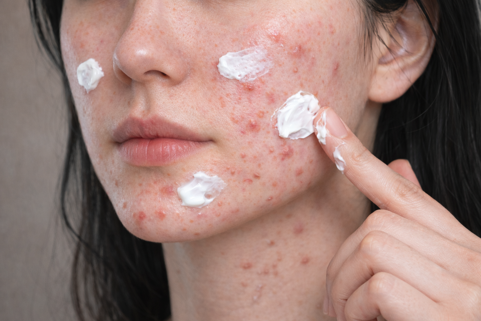 아젤리아크림 효과